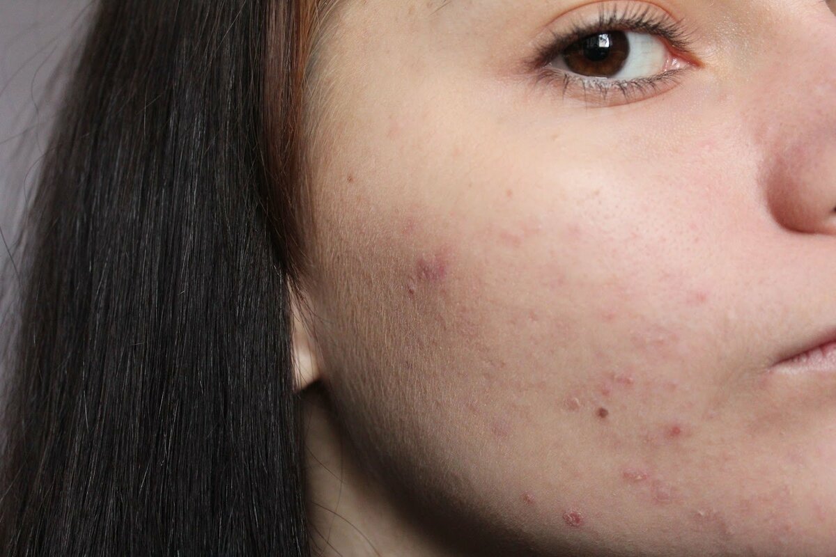 Как правильно ухаживать за жирной кожей?