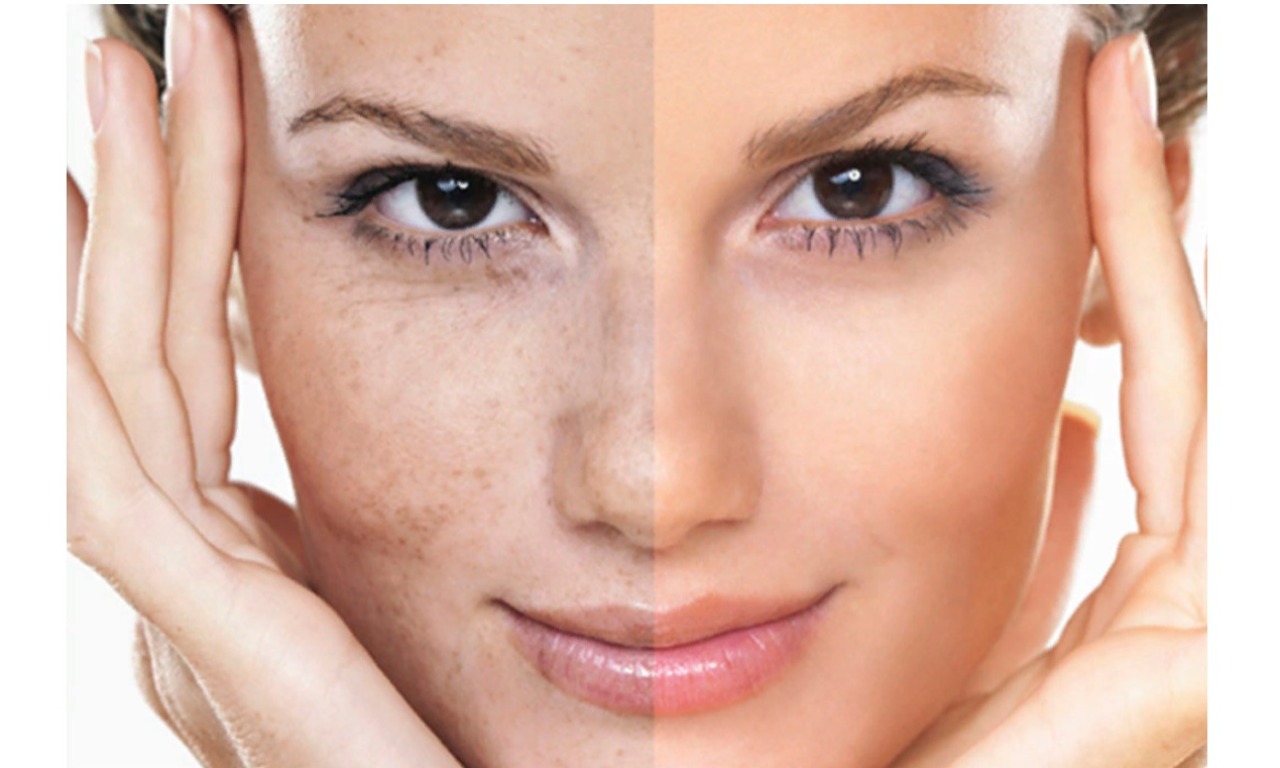 Косметологические дефекты, при которых необходима дермабразия: